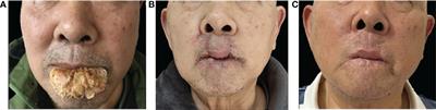 A huge verrucous carcinoma of the lower lip reconstructed by double Abbe flap: A case report and literature review